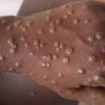 5-ka-ginasuspetsukan-nga-mpox-cases-sa-iloilo,-negatibo-suno-sa-ipho