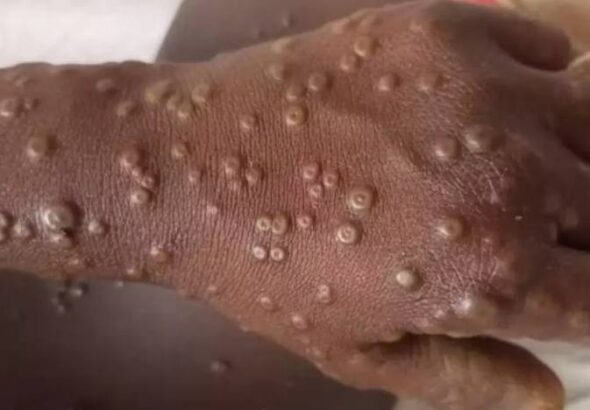 5-ka-ginasuspetsukan-nga-mpox-cases-sa-iloilo,-negatibo-suno-sa-ipho