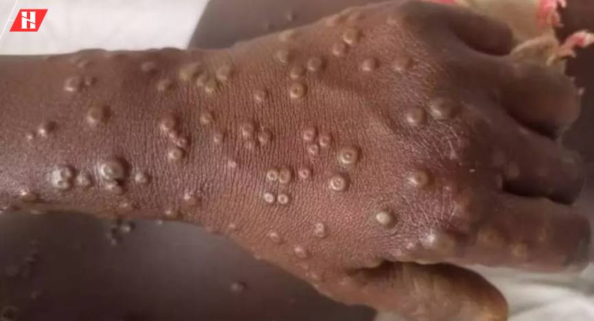 5-ka-ginasuspetsukan-nga-mpox-cases-sa-iloilo,-negatibo-suno-sa-ipho